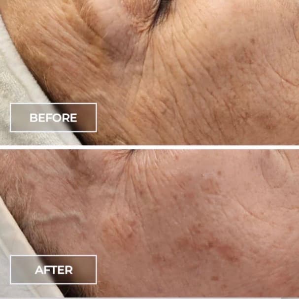 High Elevation Peel Series at Alpine Glow Aesthetics, LLC in Colorado Springs, CO